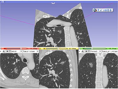 LungCT Slicer Figure1 Ming Li.jpg
