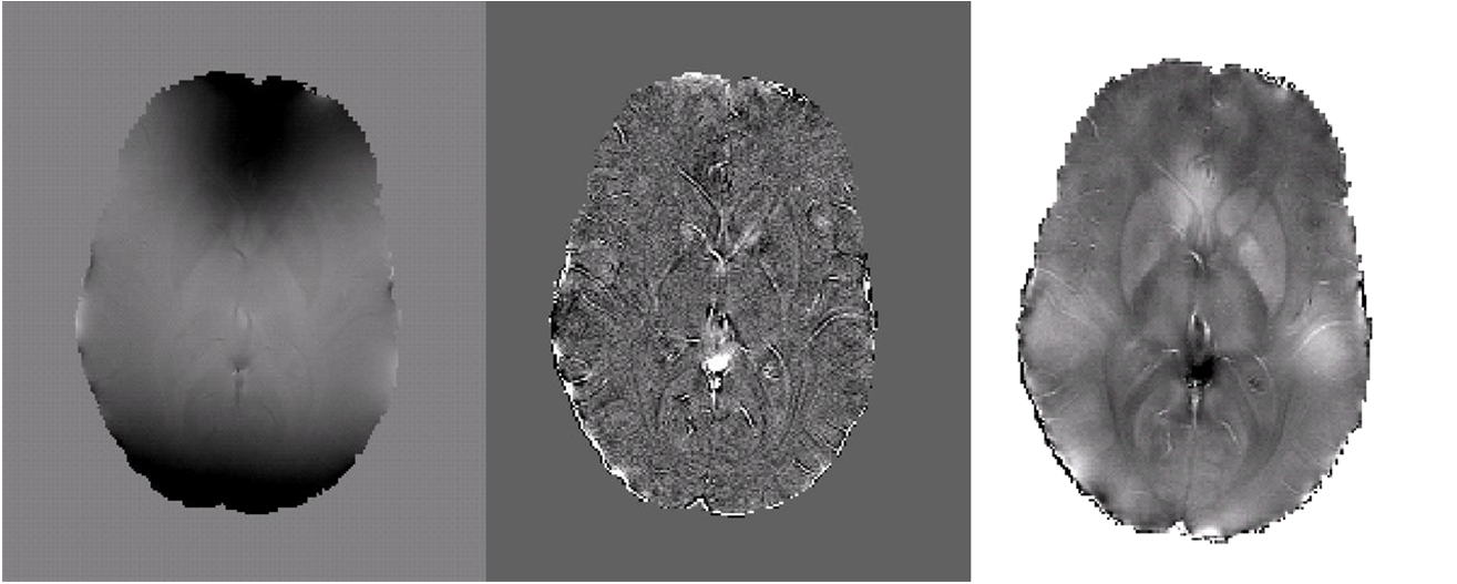 Fig 5. The field map (left), laplacian of the field (center) and estimated susceptibility map (right) for a young healthy subject is shown above. Taking the Laplacian of the fieldmap successfully eliminates the substantial biasfields in the observed field map. The estimated susceptibility map shares similar high frequency structure with the Laplacian of the observed field while low frequency structure is preserved by additional modeling constraints.