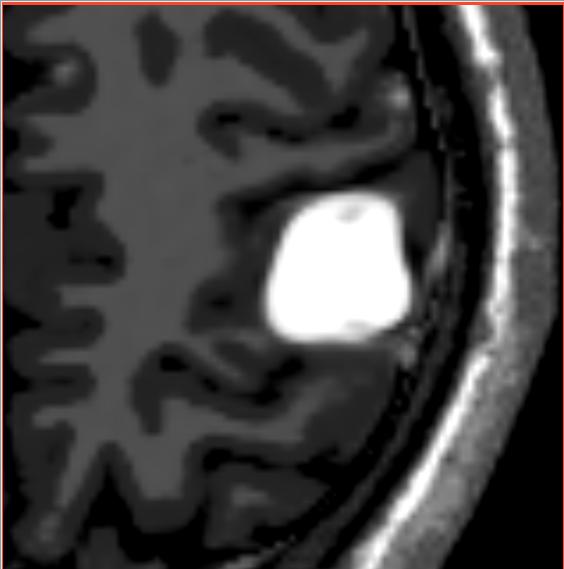 File:Meningiomasim iter1.jpg