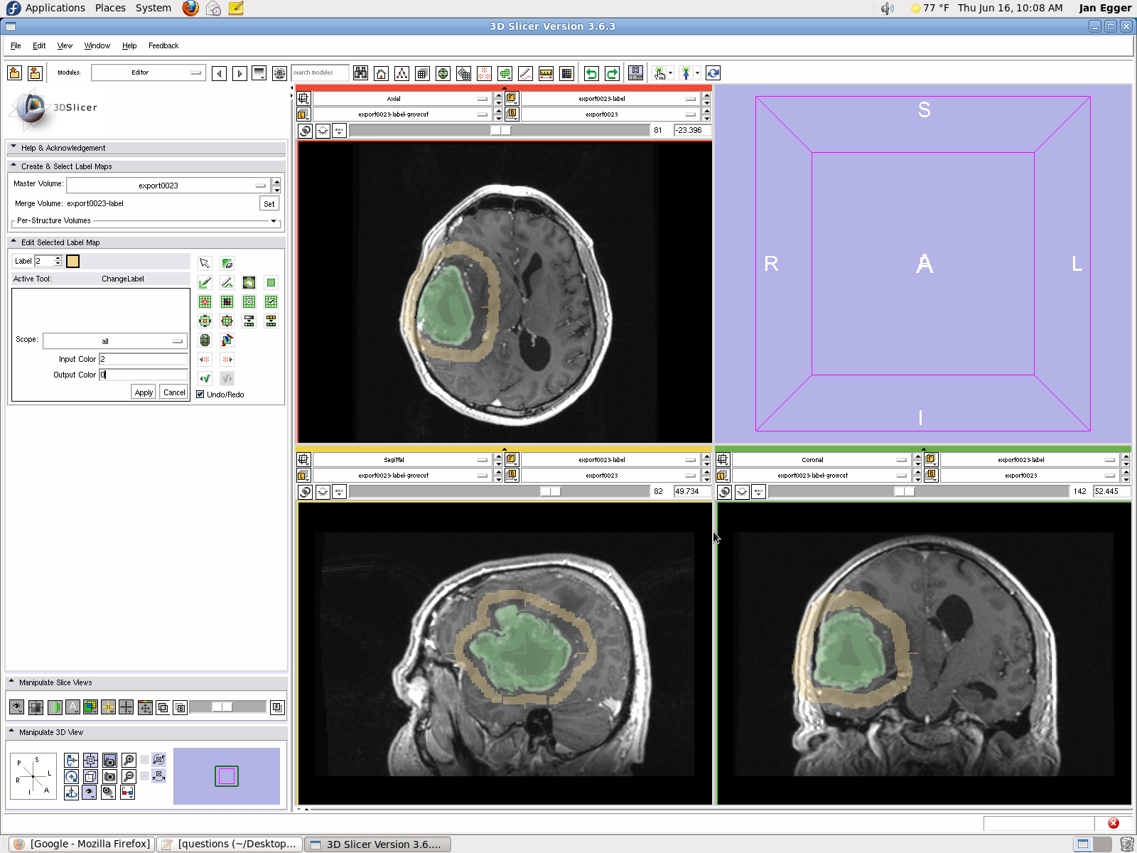 An example segmentation obtained for a challenging case of GBM from Marburg