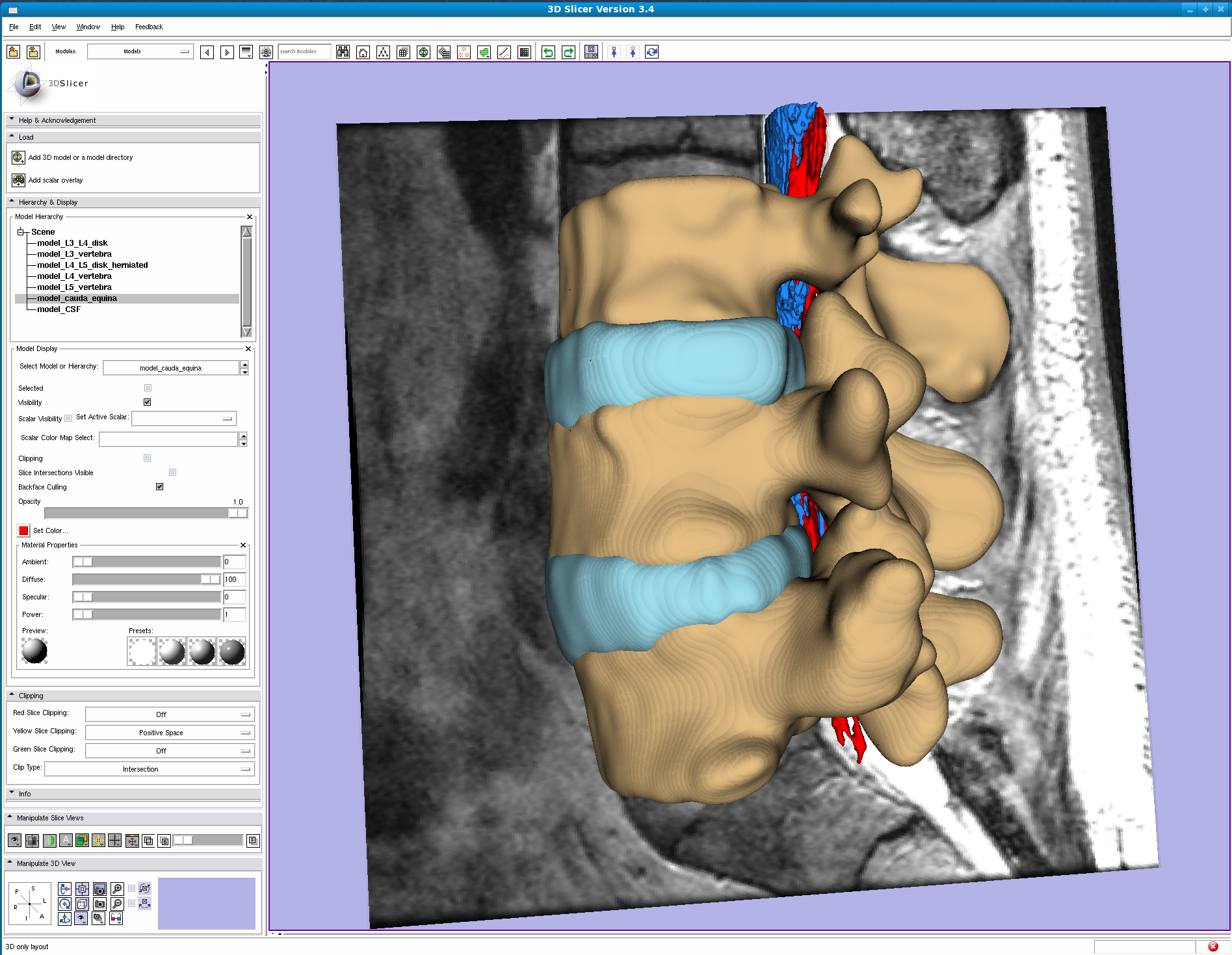 Our goal is to develop a Slicer module to automatically segment the spine in 3D MRI images to help during the surgical removal of herniated discs. (See a video)