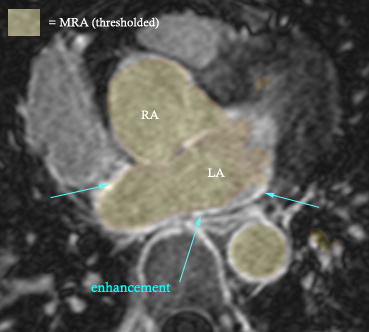 Example contrast MRI with thresholded MRA as color overlay and areas of enhancement marked