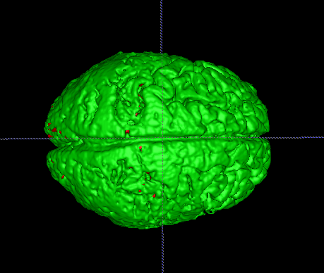 File:Top view patient3 time1.png