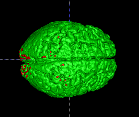 File:Top view patient3 time2.png