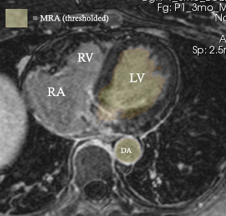 Example contrast MRI with thresholded MRA as color overlay