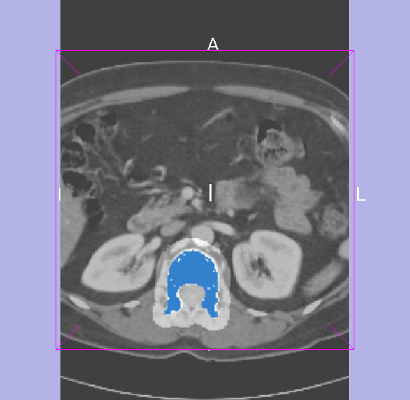 File:Segmentation dilated by slicer.png