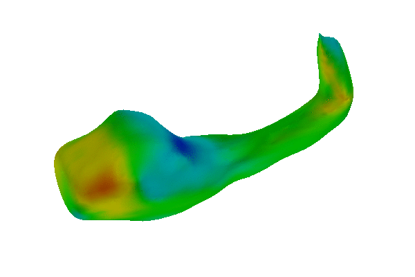 Detected shape differences in the study of hyppocampus in schizophrenia. The differences are represented as a defomation of a normal hippocampus (from blue - inwards defomration, to green - no deformation, to red - outward deformation).