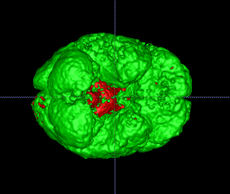 File:Bottom view patient3 time1.png