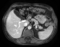 RegLib C12 LiverTumor MRI.png