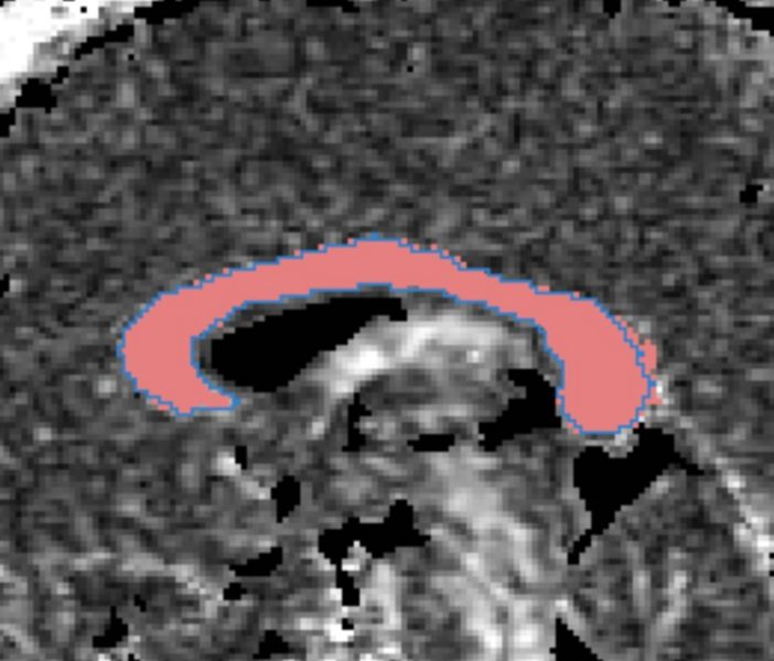 File:CaseD5 bothROIs0001.jpg