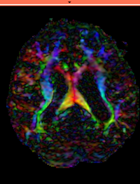 this is the DTI volume to be aligned. The calculated transform is applied to this image