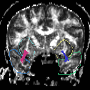 CaseD00935 tracts cut.png