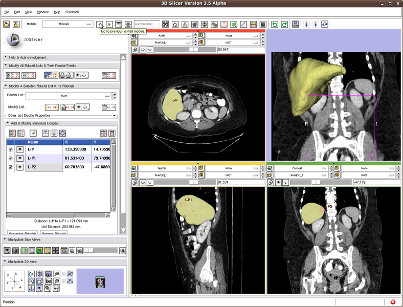 File:RobustStatisticsSegmentation Liver.png