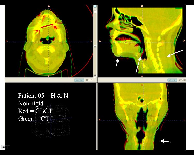 File:RadOnc HN5 deformable.jpeg