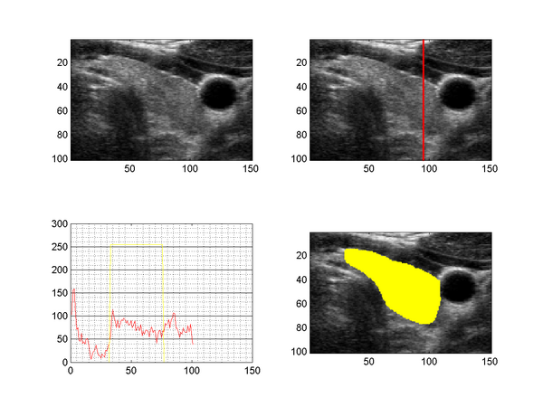 Bias Field on Ultrasound Image and Segmentation of the Thyroid
