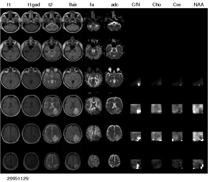File:Multimodal glioma.png