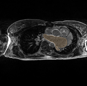 Carma hypertrophy.png