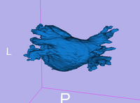 Mdepa MRA seg 3D.png