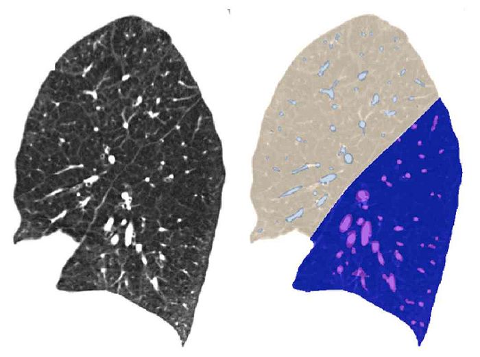 Namic2015 supervisedFissureEnhancement.jpg