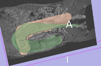 very rough surface models of colon help visualize misalignment