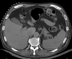 this is a pre-op CT + contrast reference image. All images are aligned into this space
