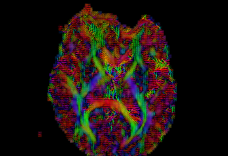 File:Chronic dti2.png