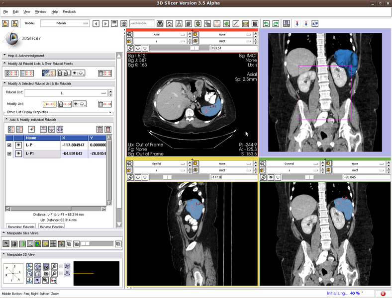 File:RobustStatisticsSegmentation Spleen.png