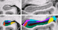 Bayesian Segmentation of Hippocampus