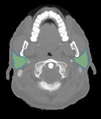 Autoseg 2013 parotids.jpg