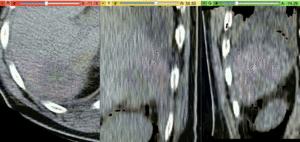 Color overlay registered MRI onto CT in the tumor area , illustrating the fusion: MRI soft tissue contrast shows substructures tour detail invisible on the CT