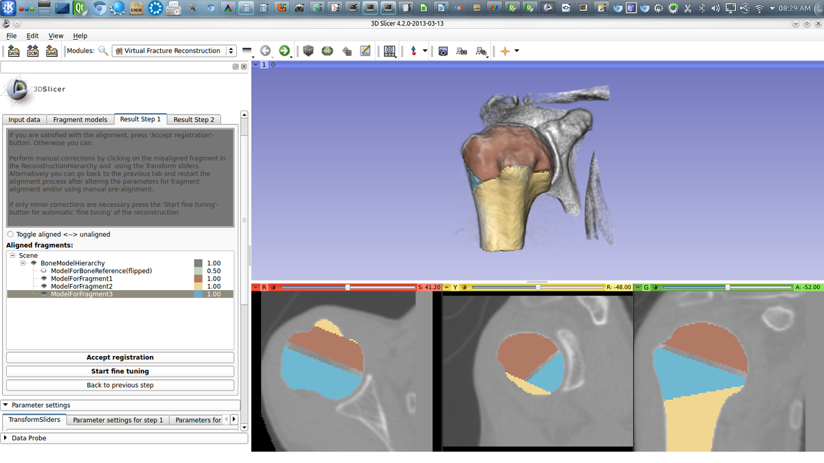 2013 Summer Project Week: Computer Assisted Surgery - NAMIC Wiki