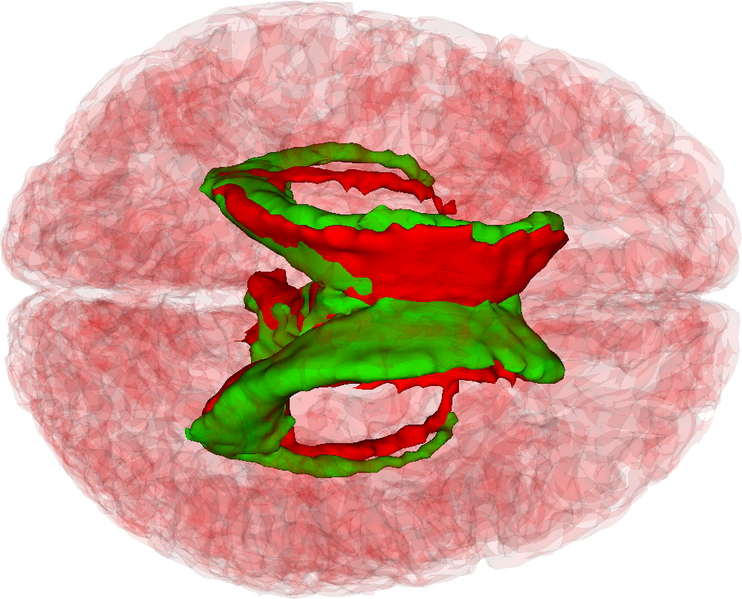File:Patient3 ventricles comparison.png