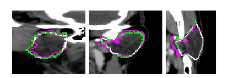 File:Mabs left parotid.png