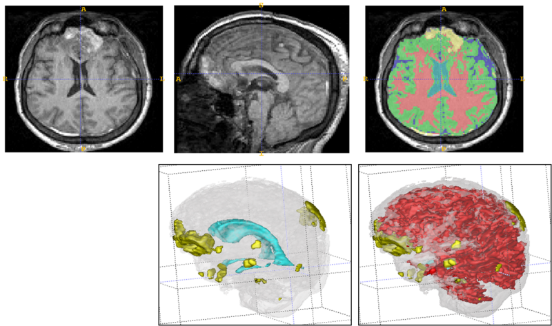 File:Slicer TBI render1.png