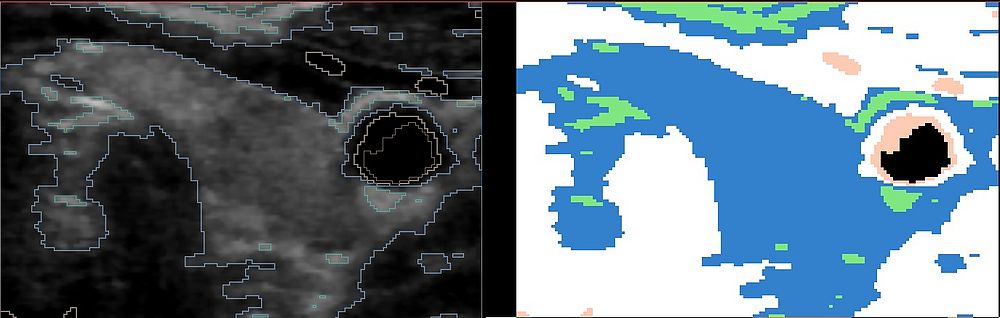Segmentation of US thyroid without atlas.