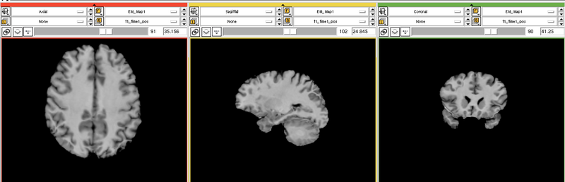 File:EMS LesionExp T1.png