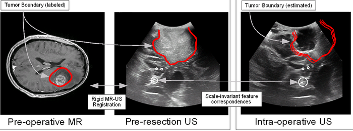 Ultrasound Guidance for Neurosurgery