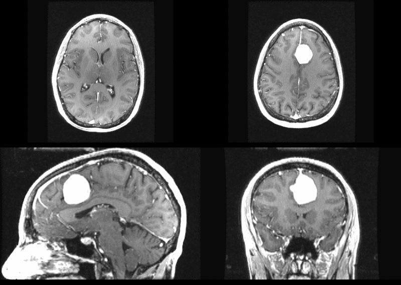 File:Tumor before.gif