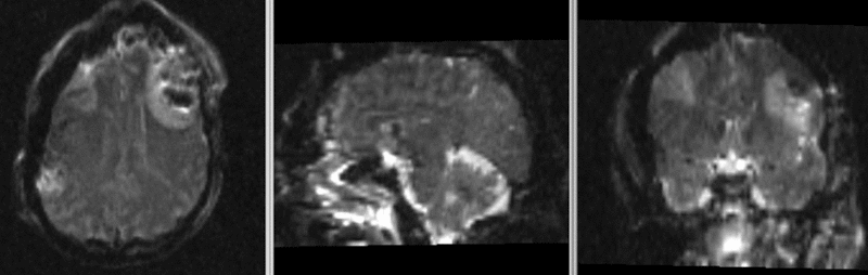 File:RegLib TBI e1 DWI-T1.gif