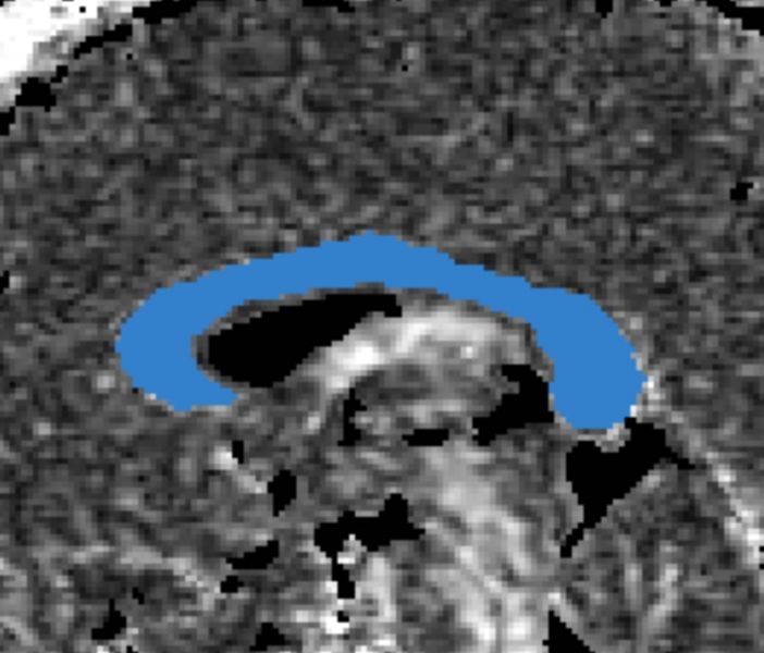 File:CaseD5 newROI0001.jpg