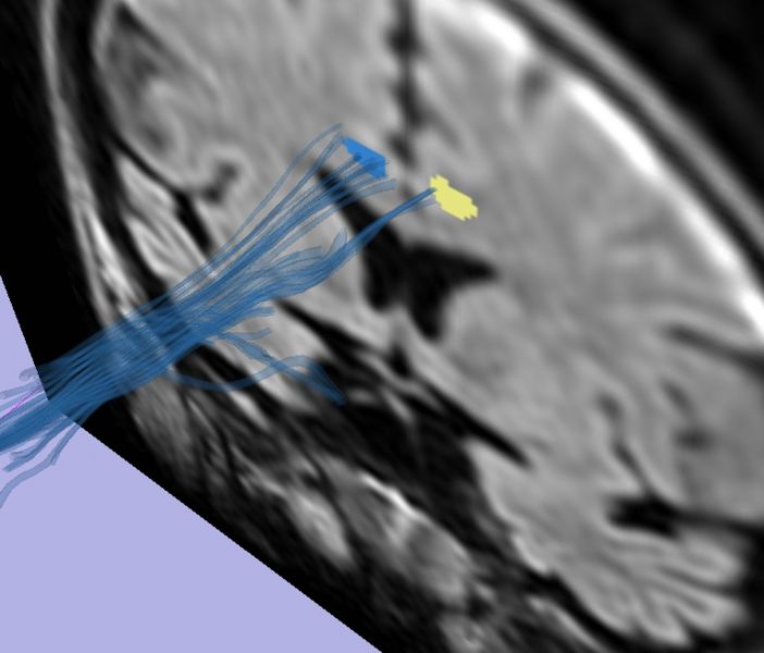 File:Semitransparent tracts.jpg