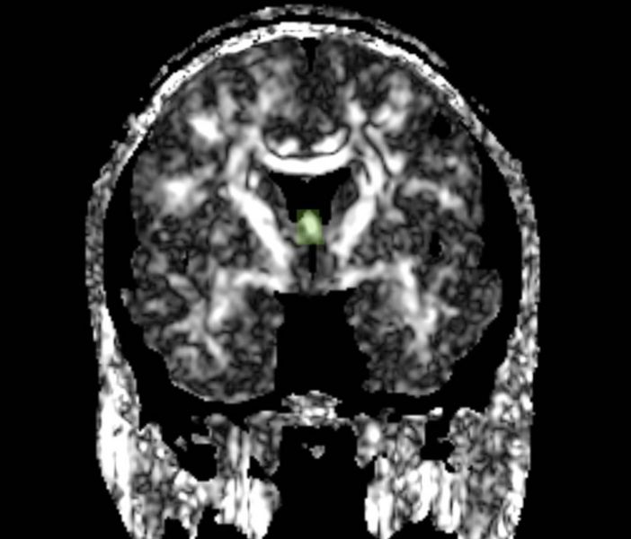 File:Fornix roi1.jpg