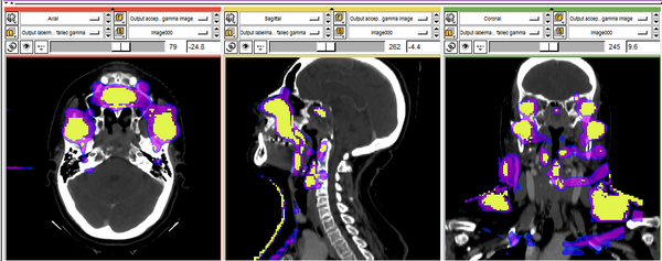 Image of gamma index in Slicer 3