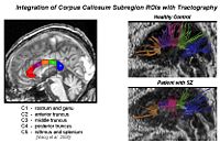 NAMIC callosum tracts prelim.jpg