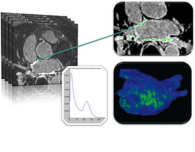 The CARMA Center's Utah classification for Atrial Fibrillation staging involves segmentation of the left atrial wall from MRI, followed by quantification of enhanced vs. non-enhanced voxels in the wall.