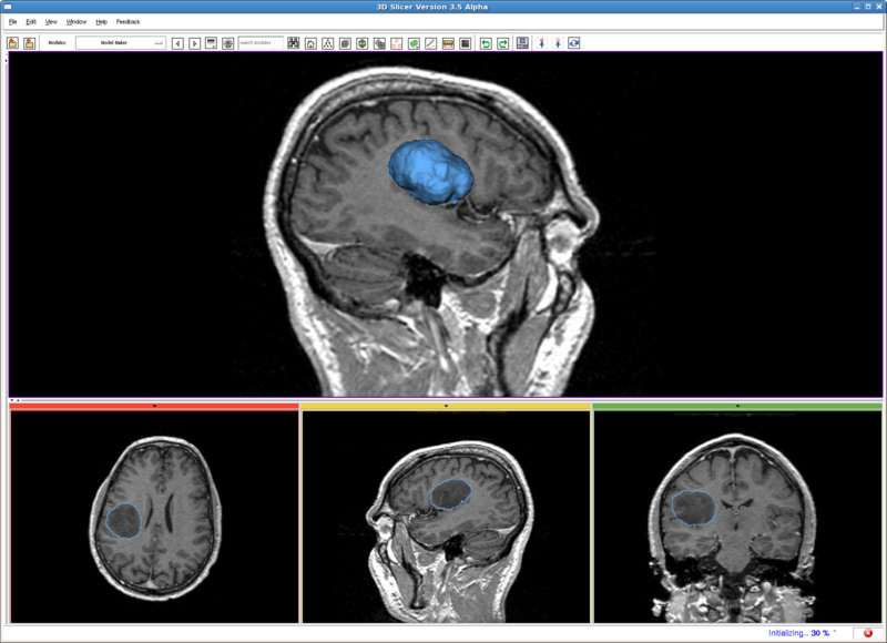 File:RSS tumor.png