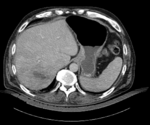 this is an intermediate pre-op CT, used as reference to match the MRI