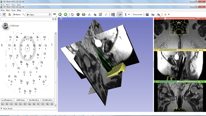 File:IGyne-ScreenShot of Needle Visualization.png