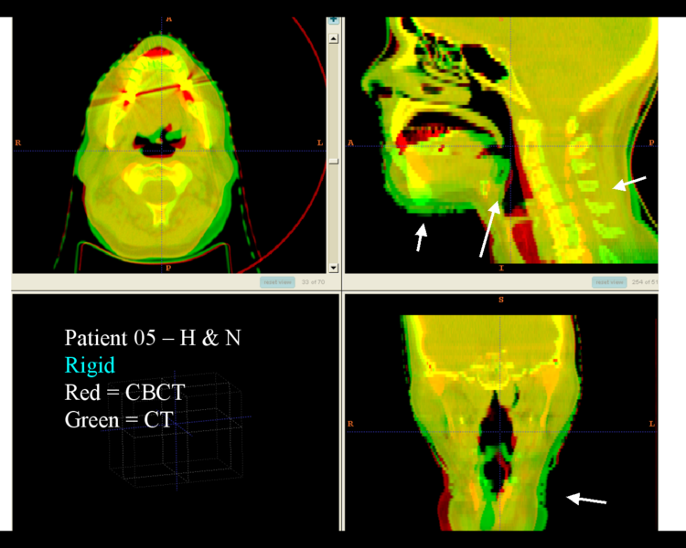 File:RadOnc HN5 rigid.png