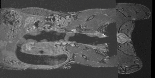 after surface registration (rigid) + manual correction